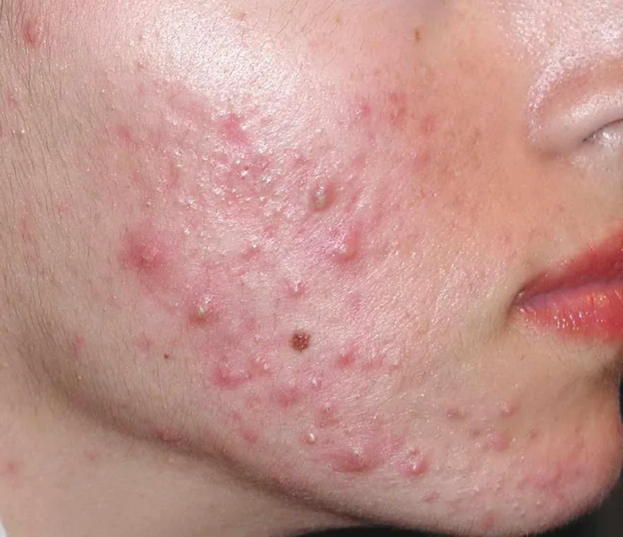 Piel con acné inflamatorio — abordaje médico-estético en Brava Clinic