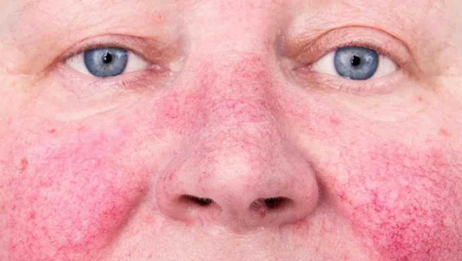 Piel con rosácea o sensibilidad — plan calmante en Brava Clinic