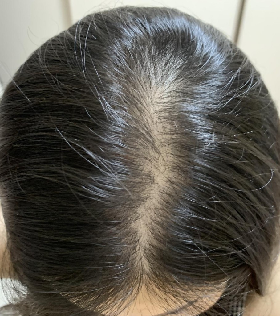 Caída de cabello en la mujer — valoración en Brava Clinic