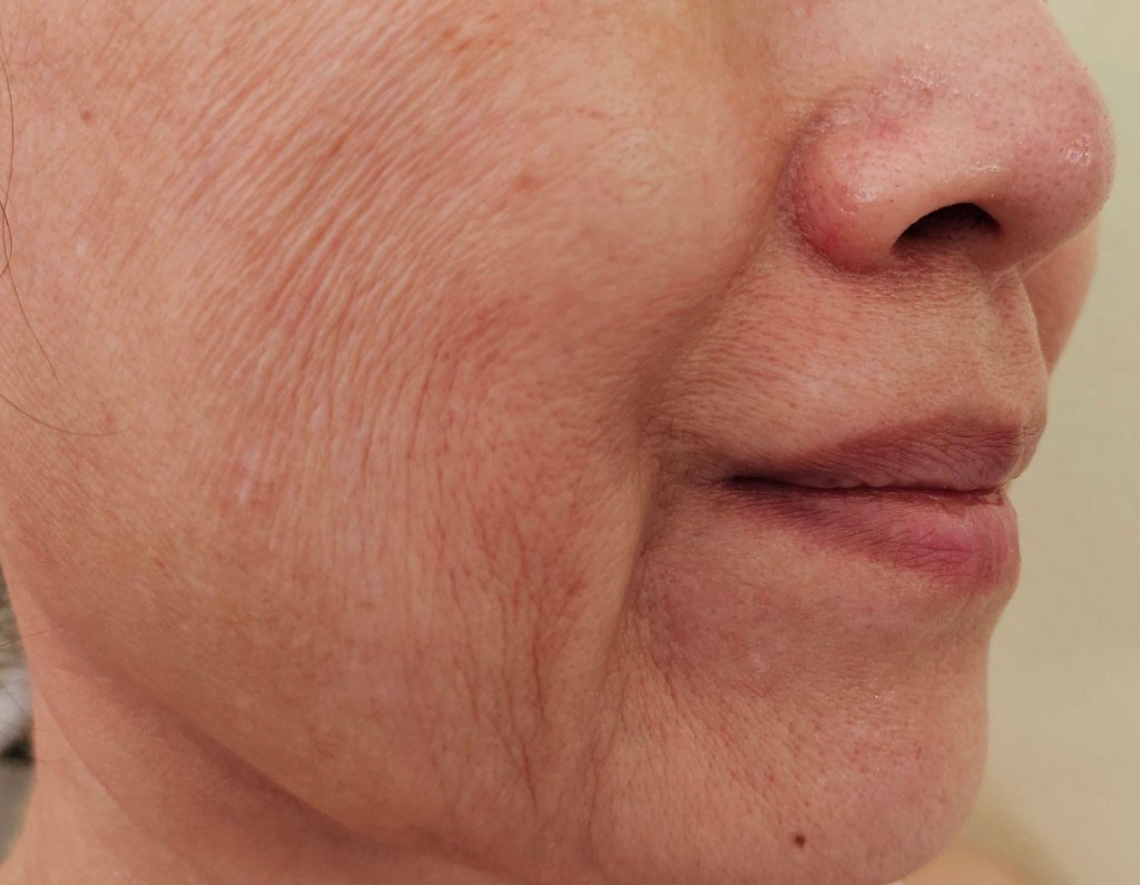 Piel en menopausia — protocolo en Brava Clinic