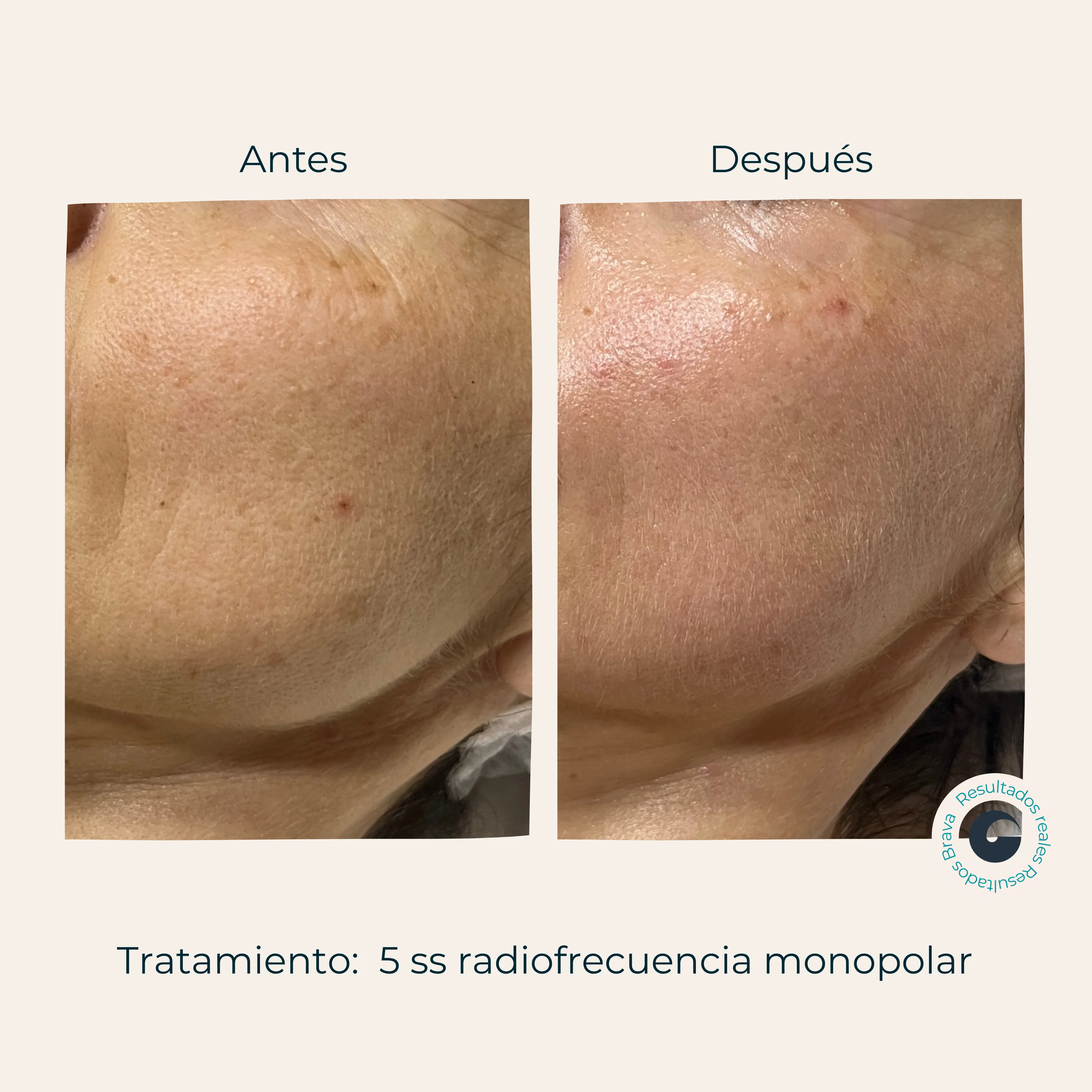 Antes y después real (1) documentado en Brava Clinic.