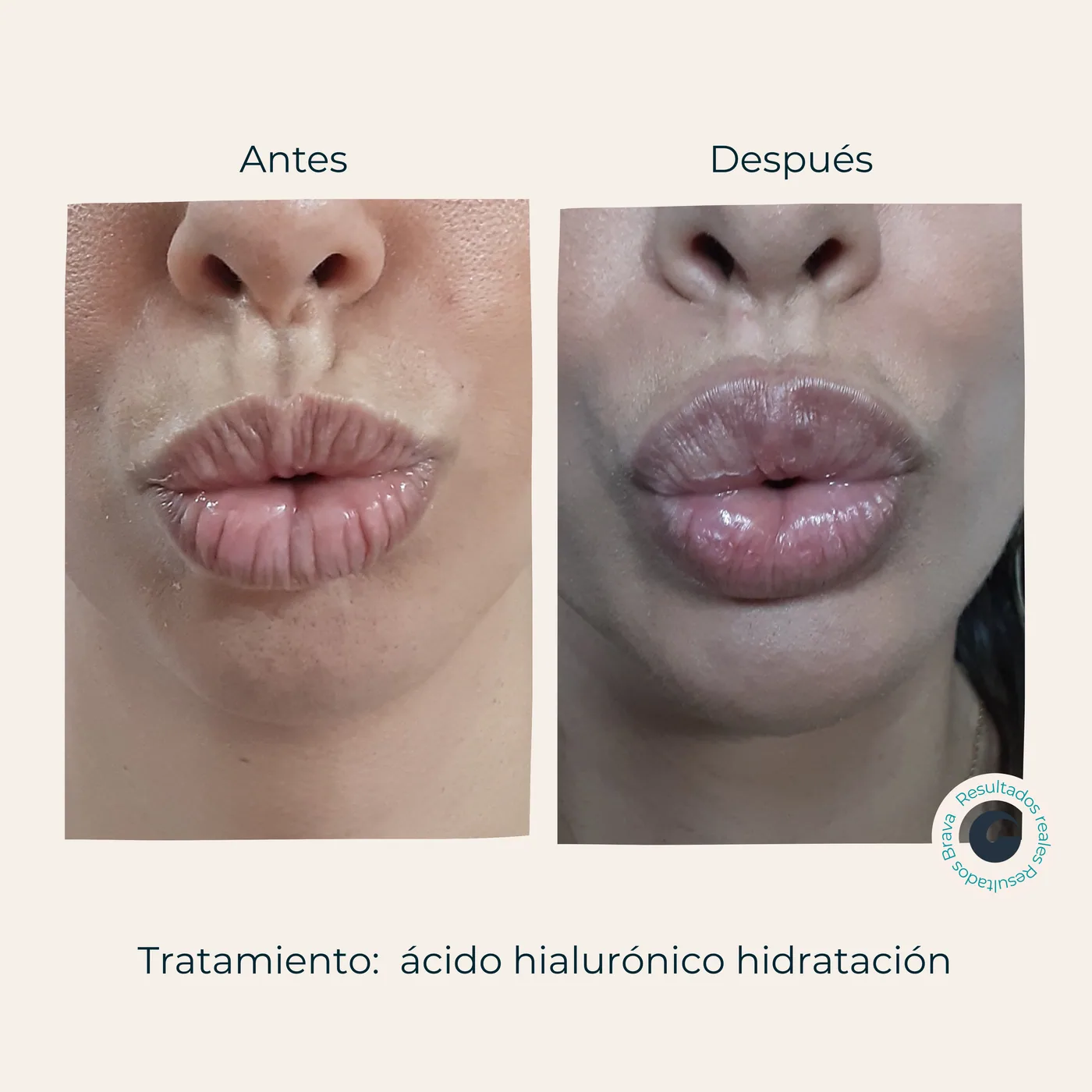 Antes y después real (10) documentado en Brava Clinic.