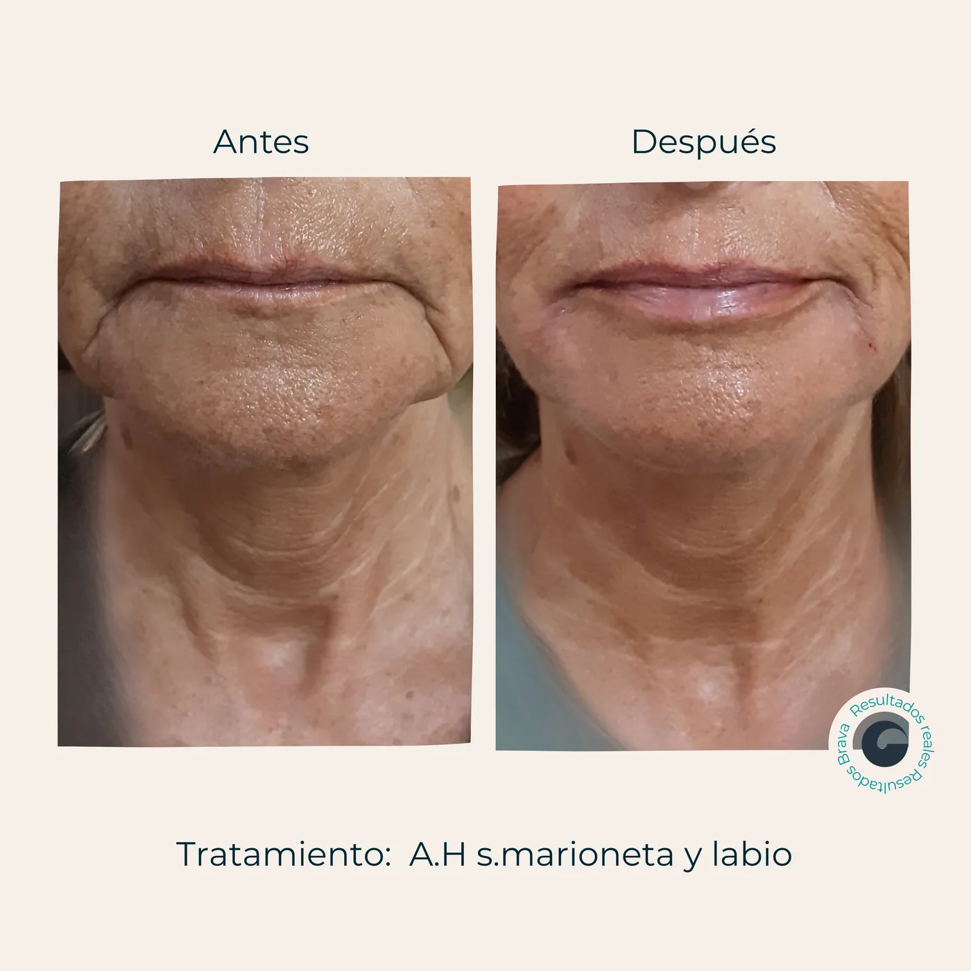 Antes y después real (11) documentado en Brava Clinic.