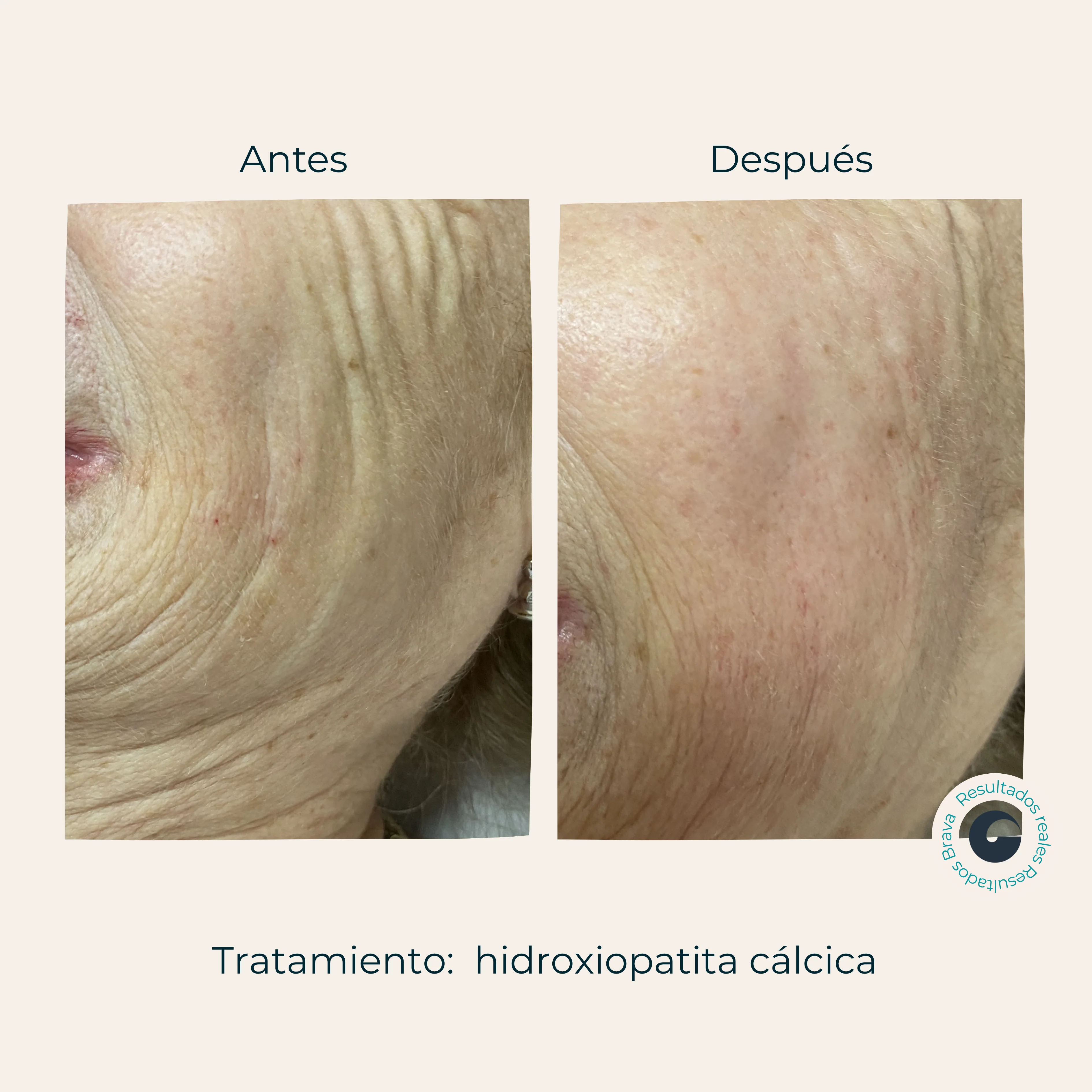 Resultado Hidroxiapatita cálcica Brava Clinic A Coruña