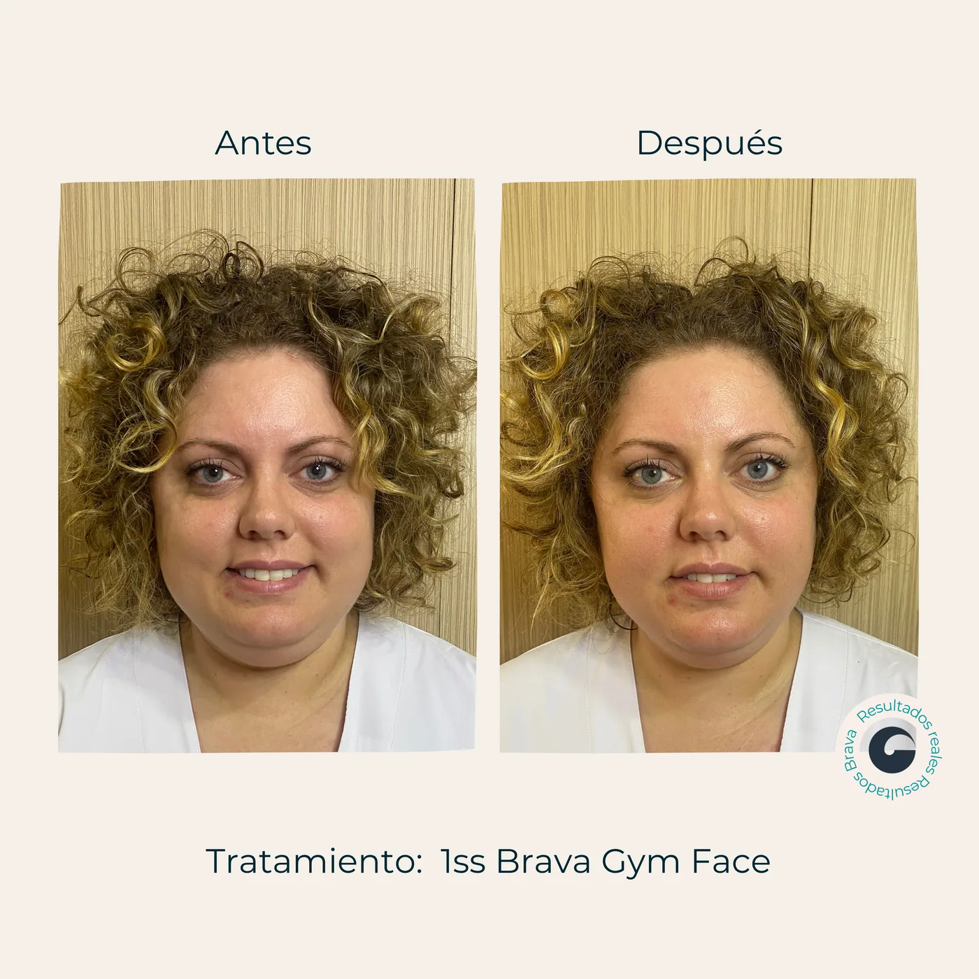 Antes y después real (13) documentado en Brava Clinic.