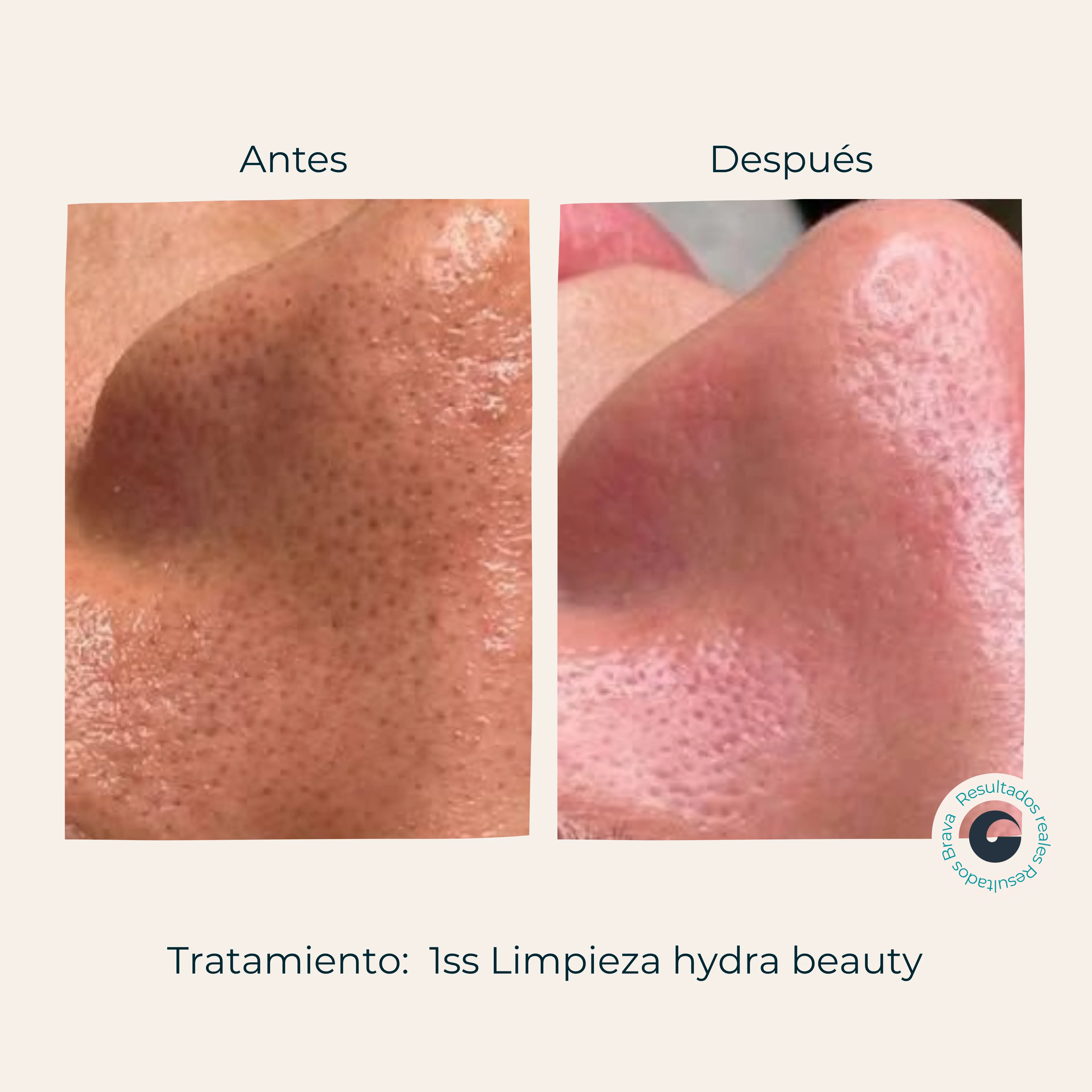 Antes y después real (14) documentado en Brava Clinic.