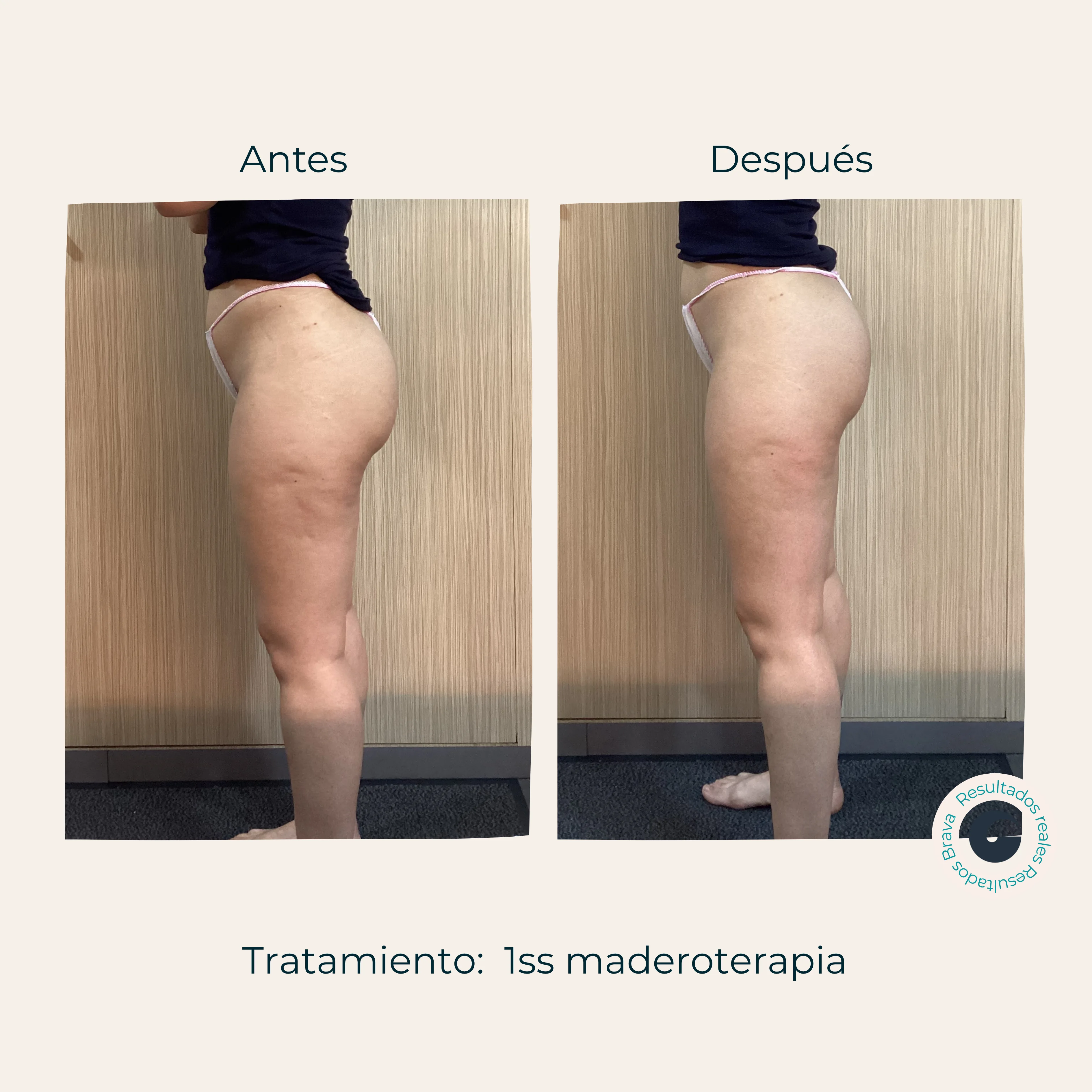 Antes y después real (15) documentado en Brava Clinic.