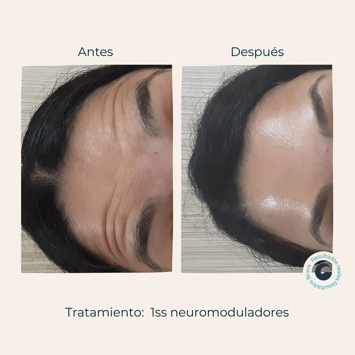 Resultado Neuromoduladores Brava Clinic A Coruña