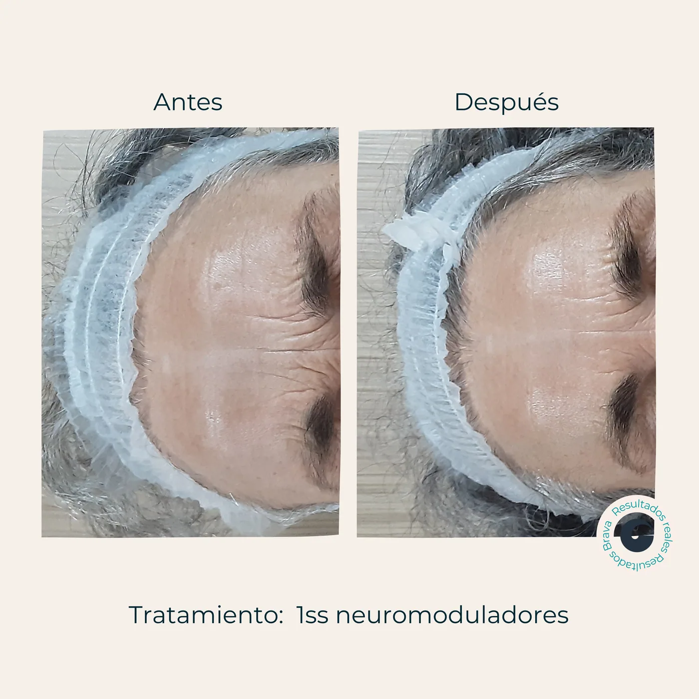 Antes y después real (17) documentado en Brava Clinic.