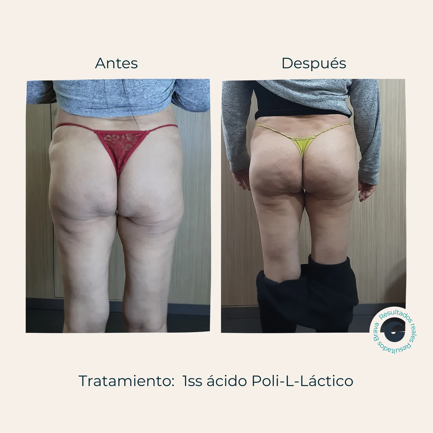 Antes y después real (18) documentado en Brava Clinic.