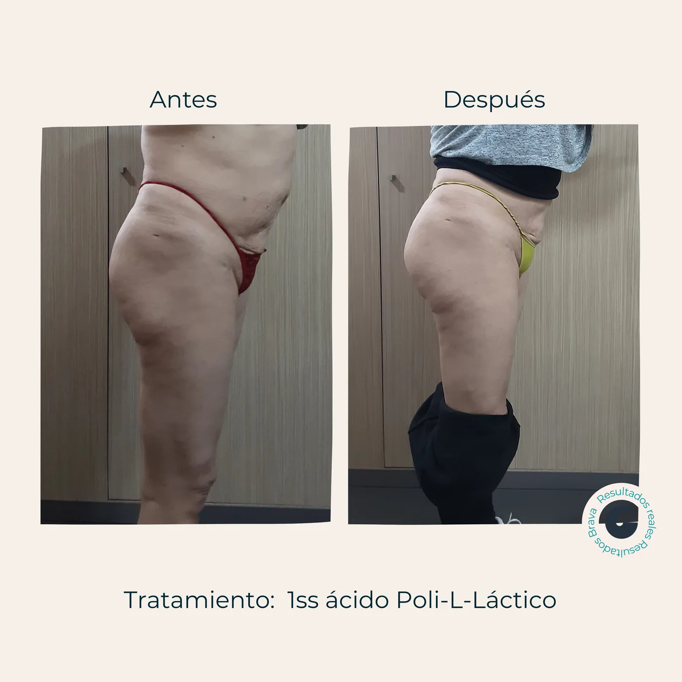 Antes y después real (19) documentado en Brava Clinic.