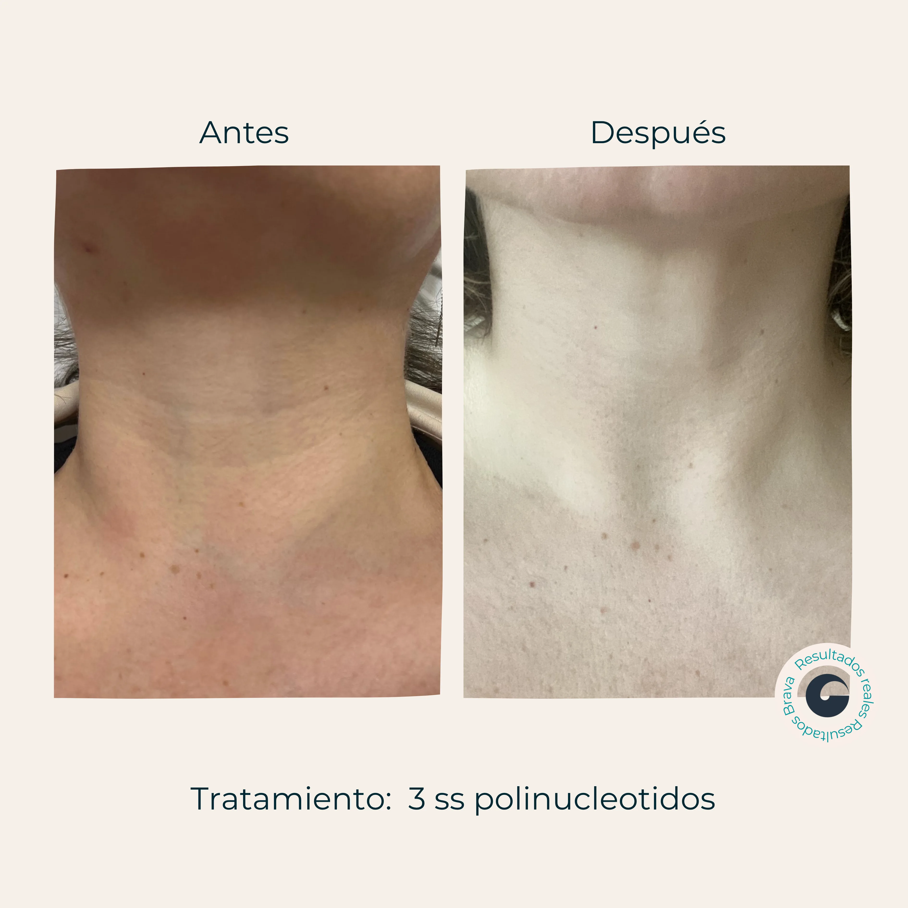 Resultado Polinucleótidos Brava Clinic A Coruña