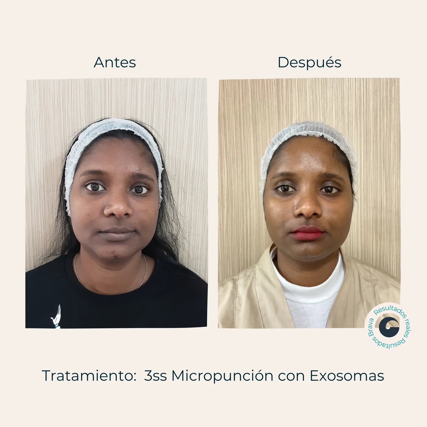 Resultado Exosomas despigmentantes + dermapen Brava Clinic A Coruña