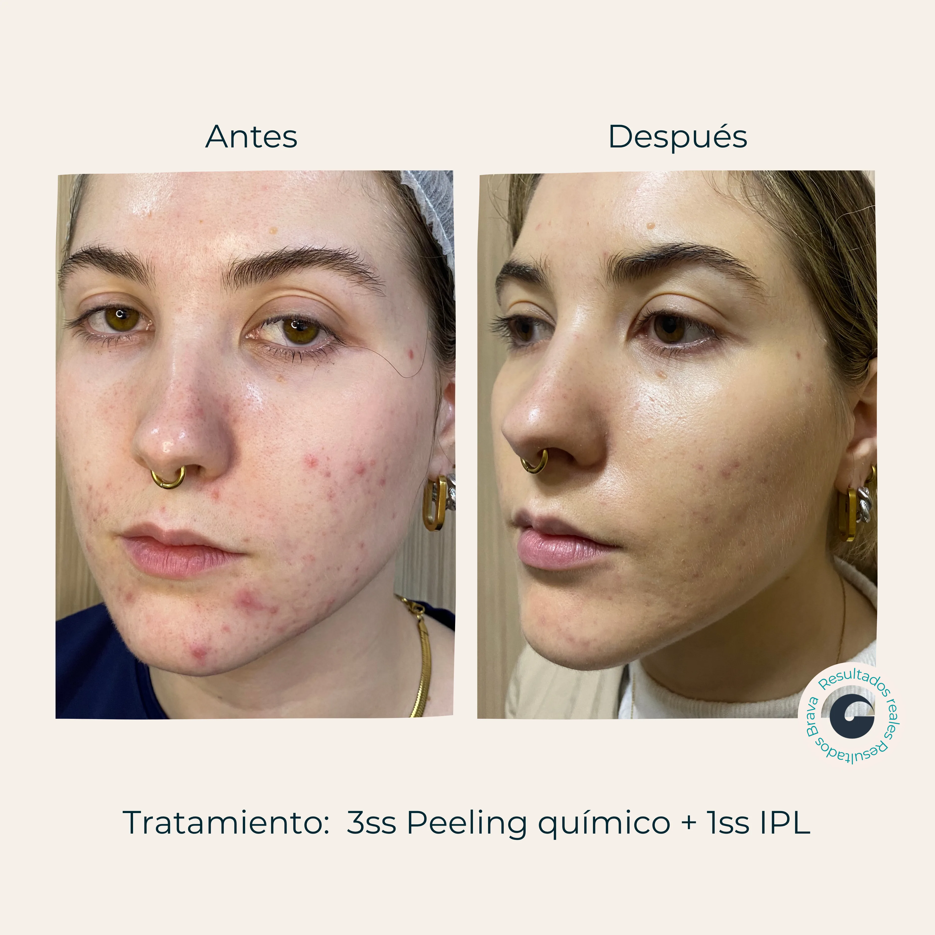 Antes y después real (21) documentado en Brava Clinic.