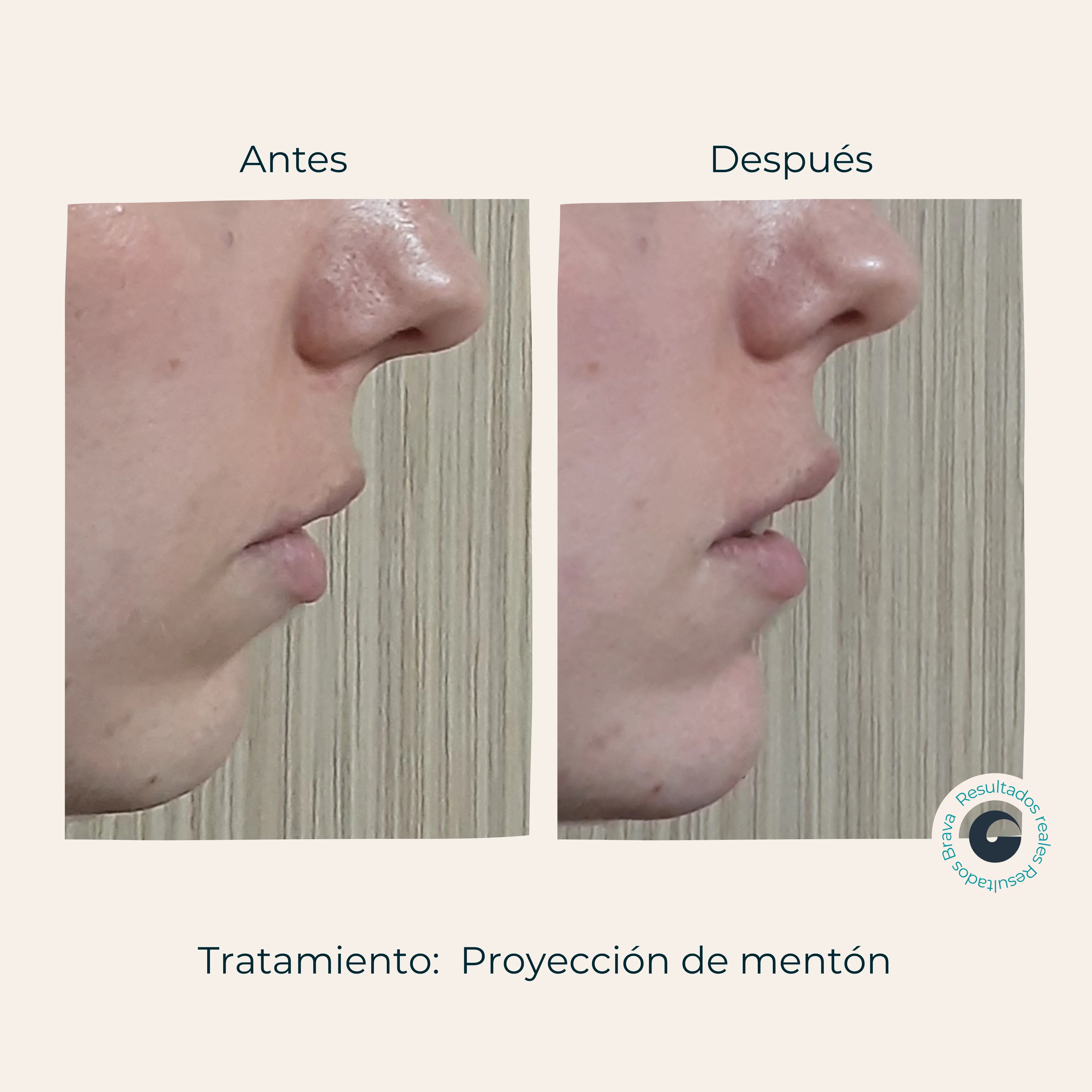 Resultado Proyección de mentón Brava Clinic A Coruña