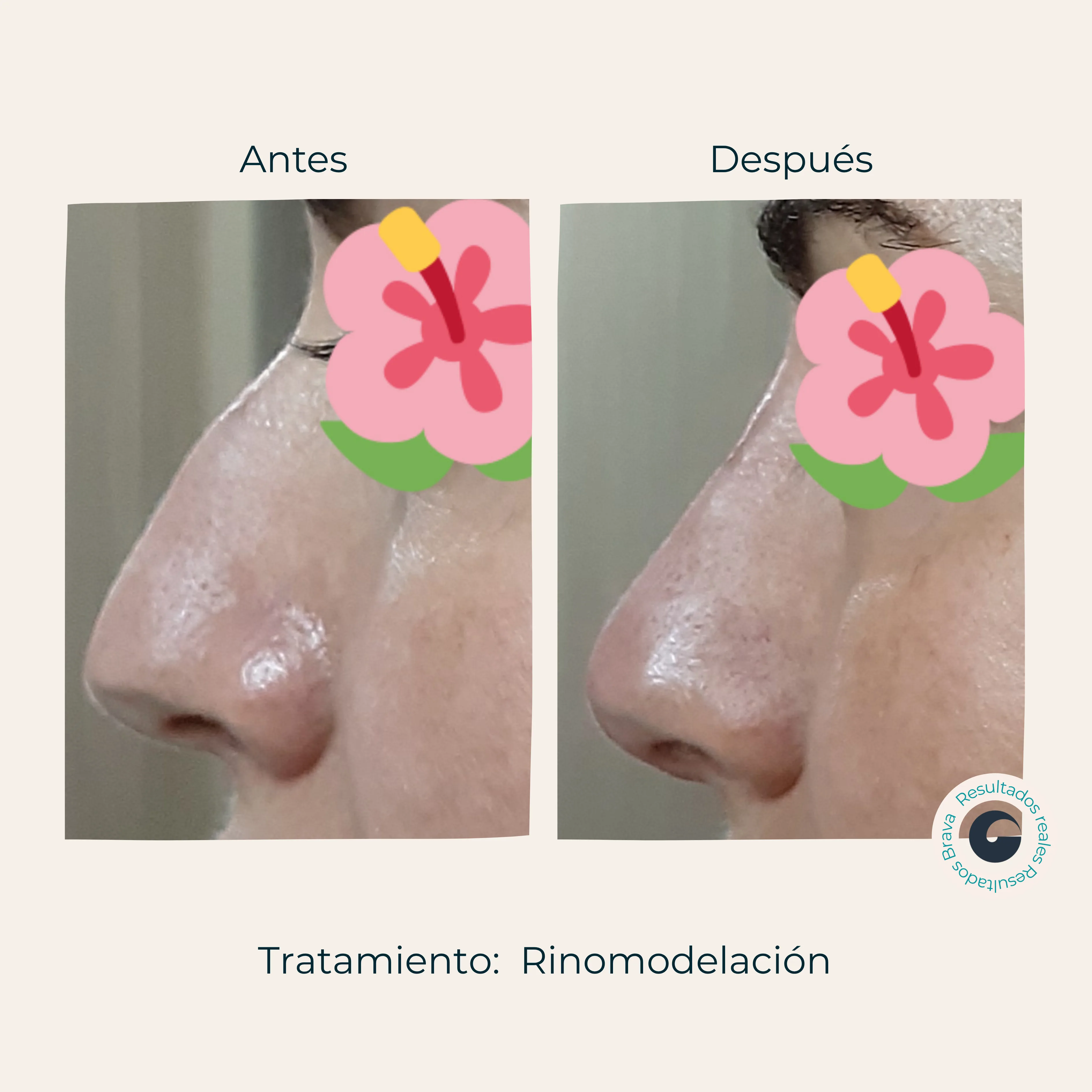 Antes y después real (24) documentado en Brava Clinic.