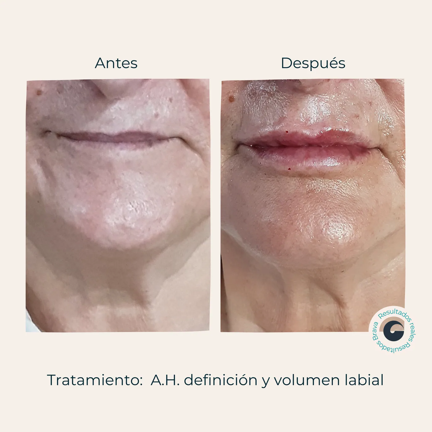 Antes y después real (25) documentado en Brava Clinic.