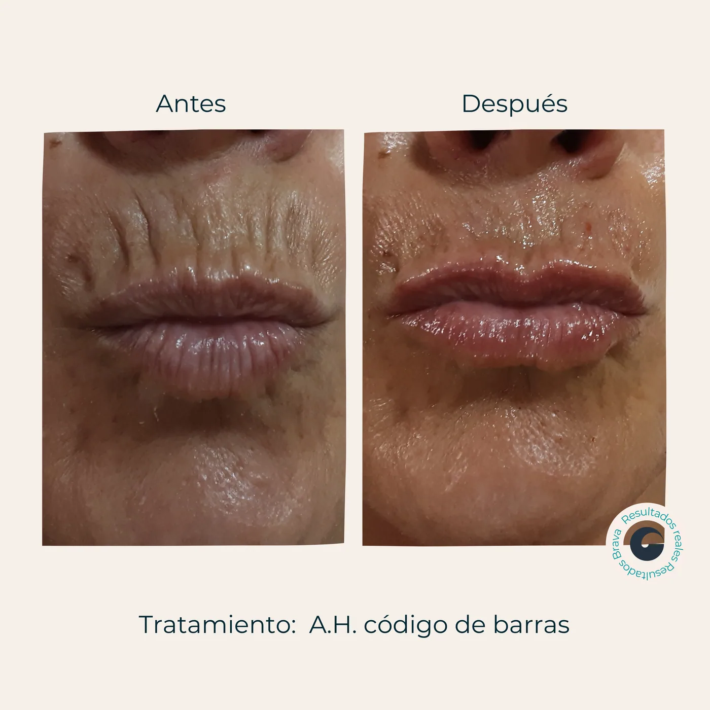 Antes y después real (26) documentado en Brava Clinic.