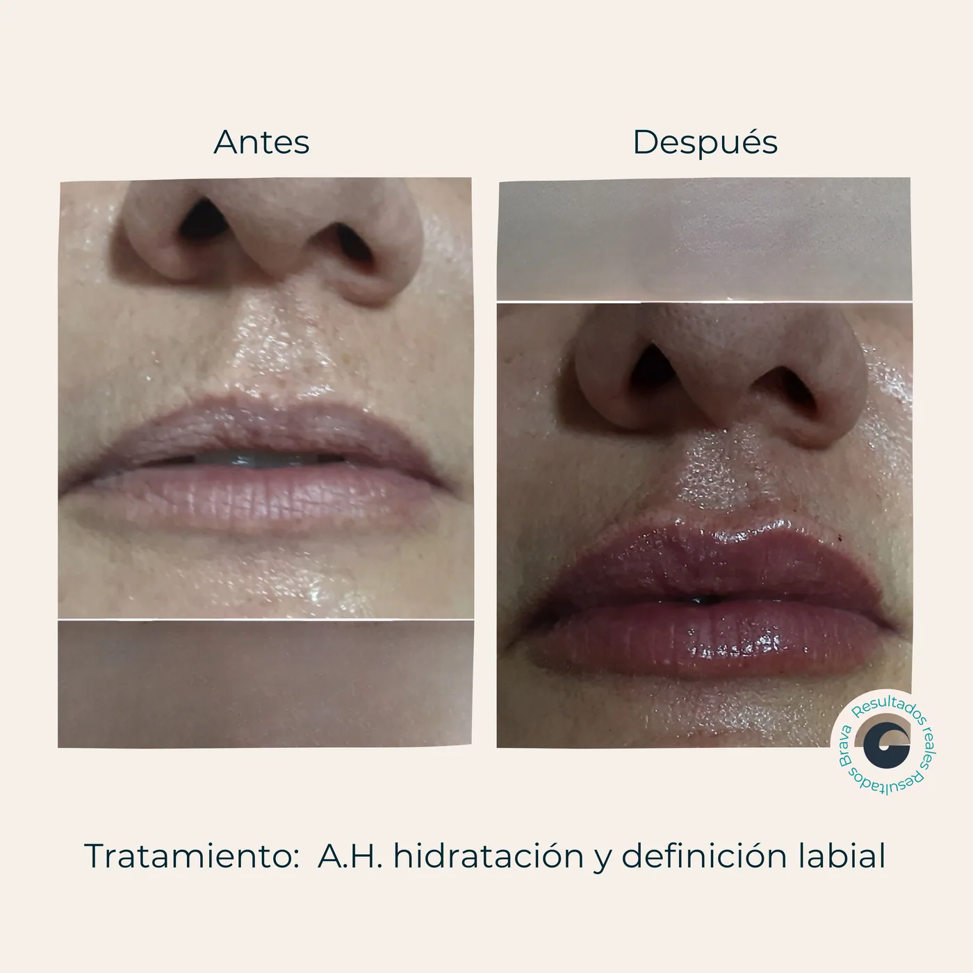 Antes y después real (27) documentado en Brava Clinic.