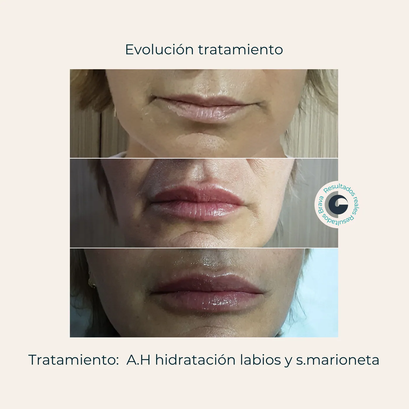 Antes y después real (28) documentado en Brava Clinic.