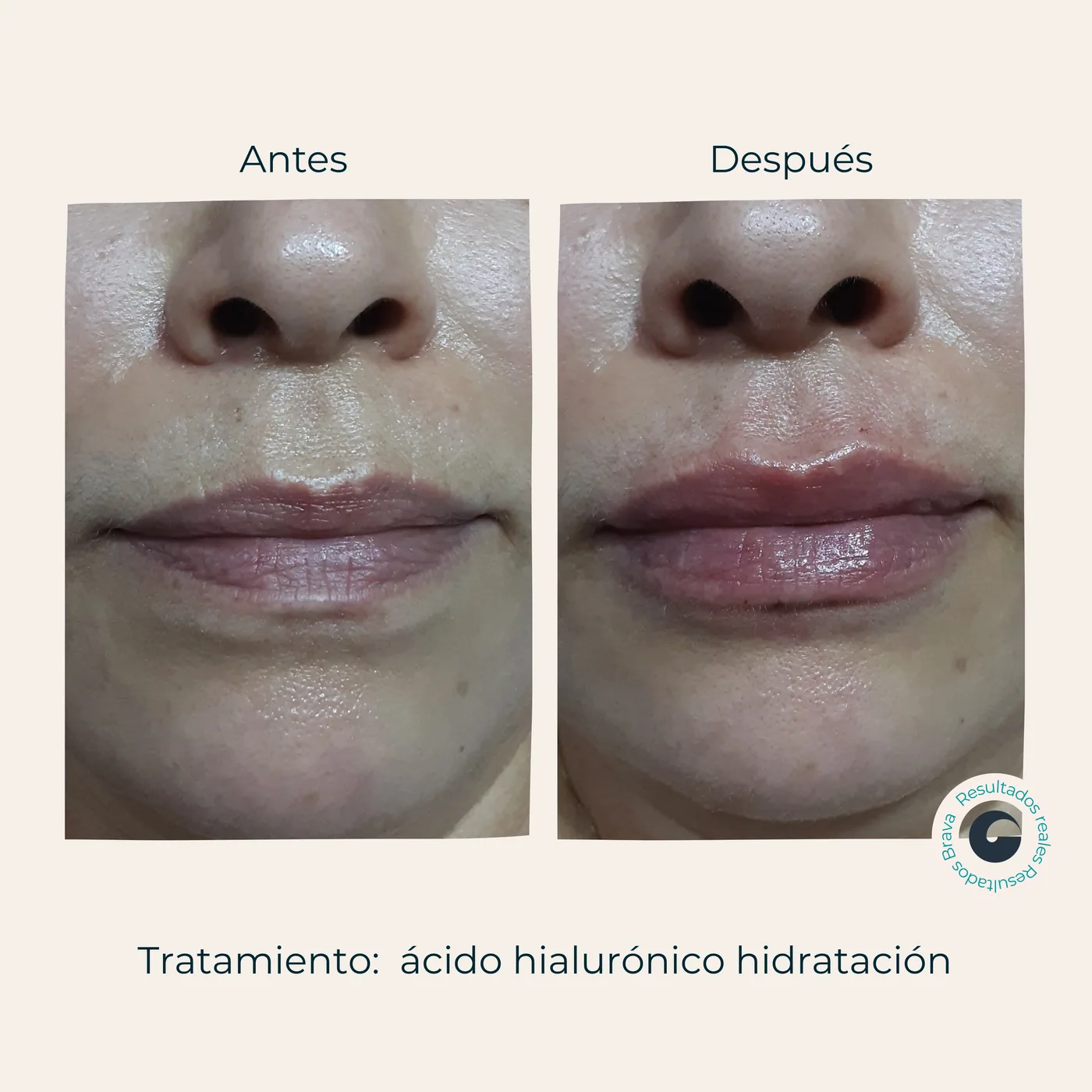 Antes y después real (3) documentado en Brava Clinic.