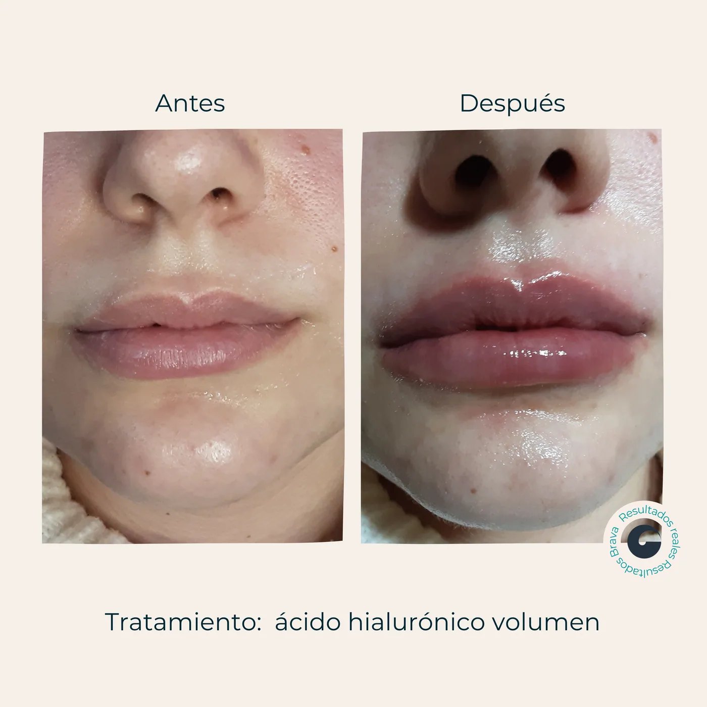 Antes y después real (4) documentado en Brava Clinic.