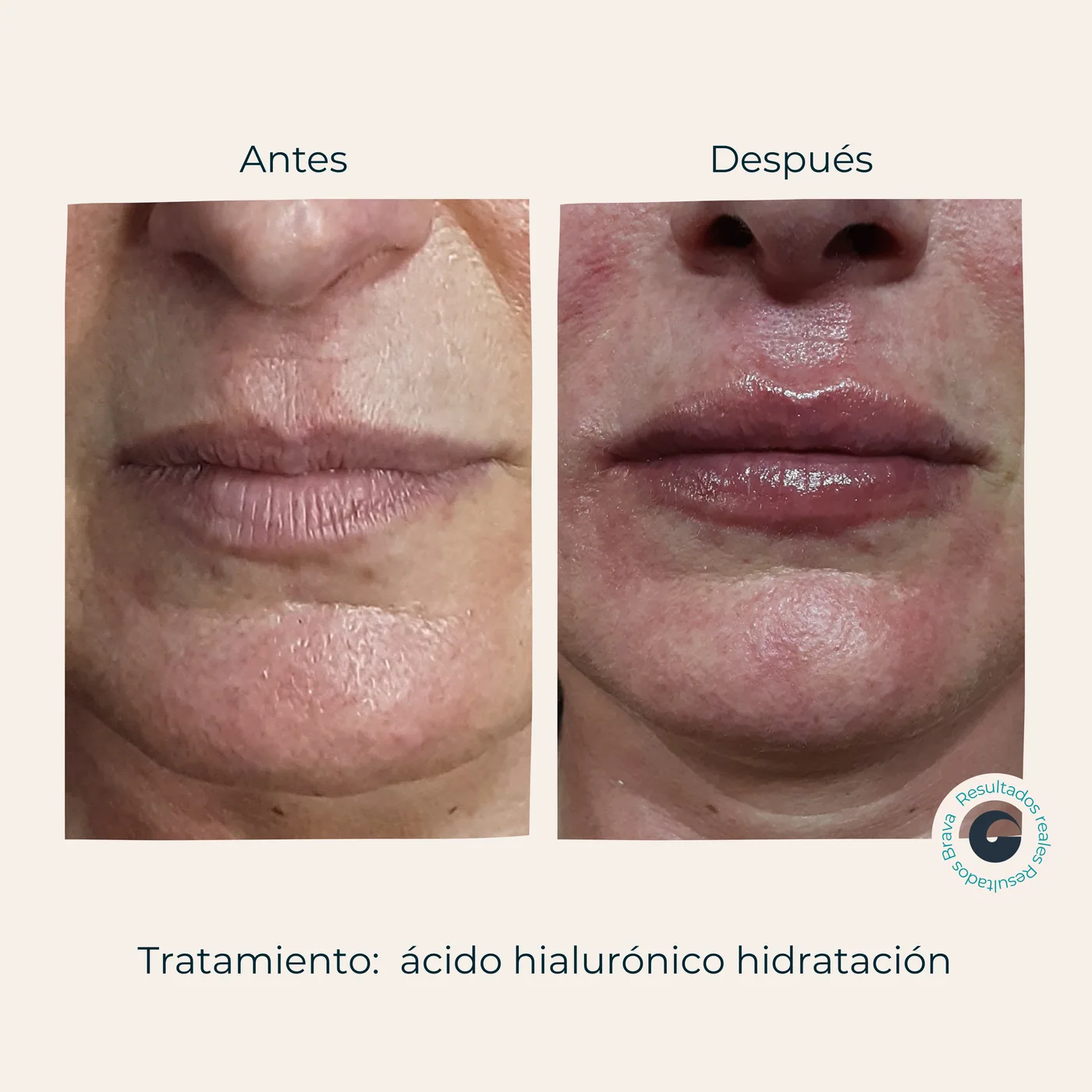 Antes y después real (5) documentado en Brava Clinic.