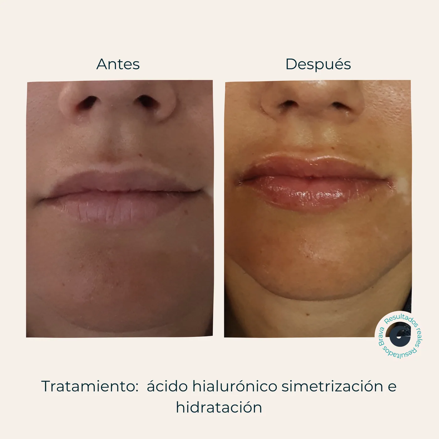 Antes y después real (6) documentado en Brava Clinic.
