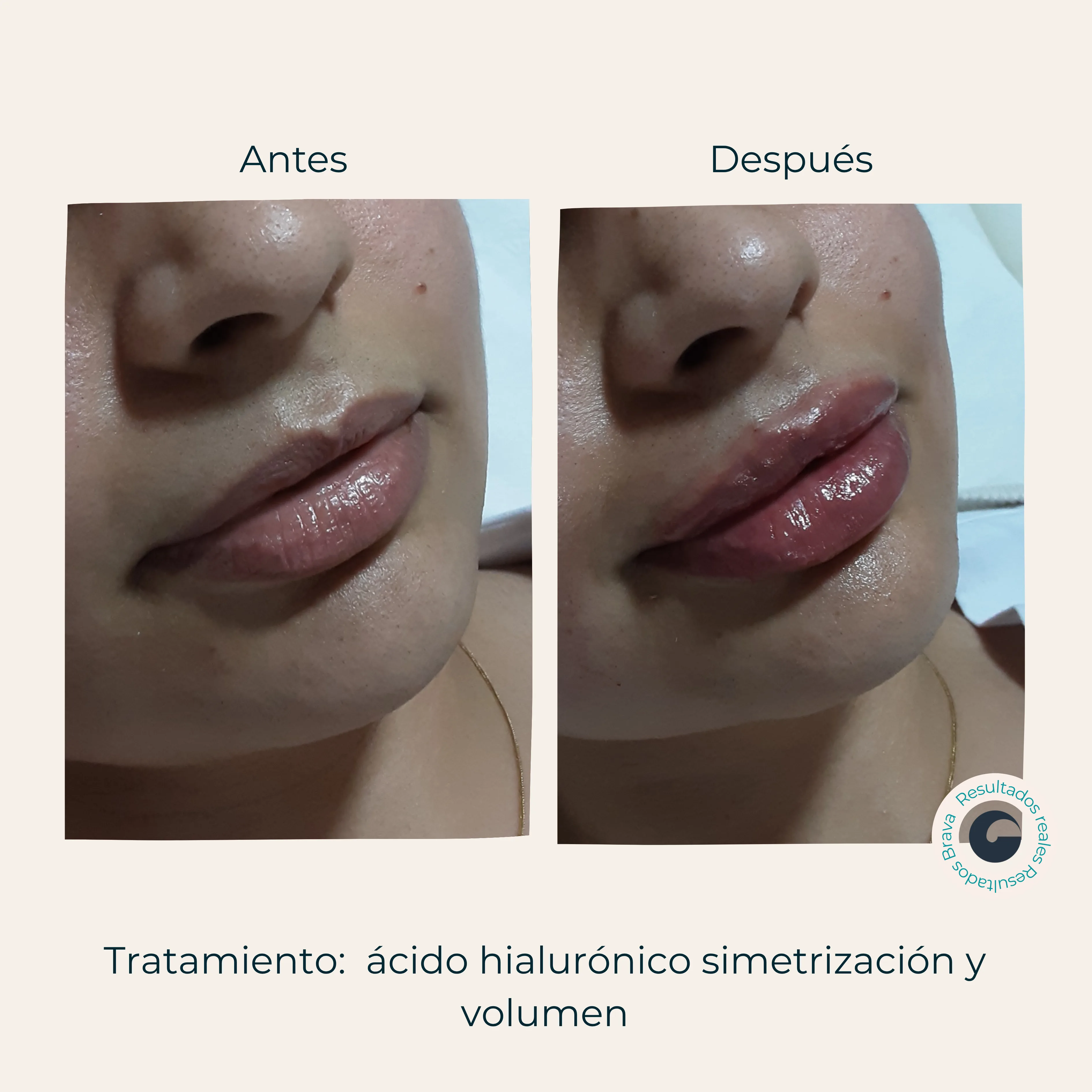 Resultado Relleno de labios Brava Clinic A Coruña