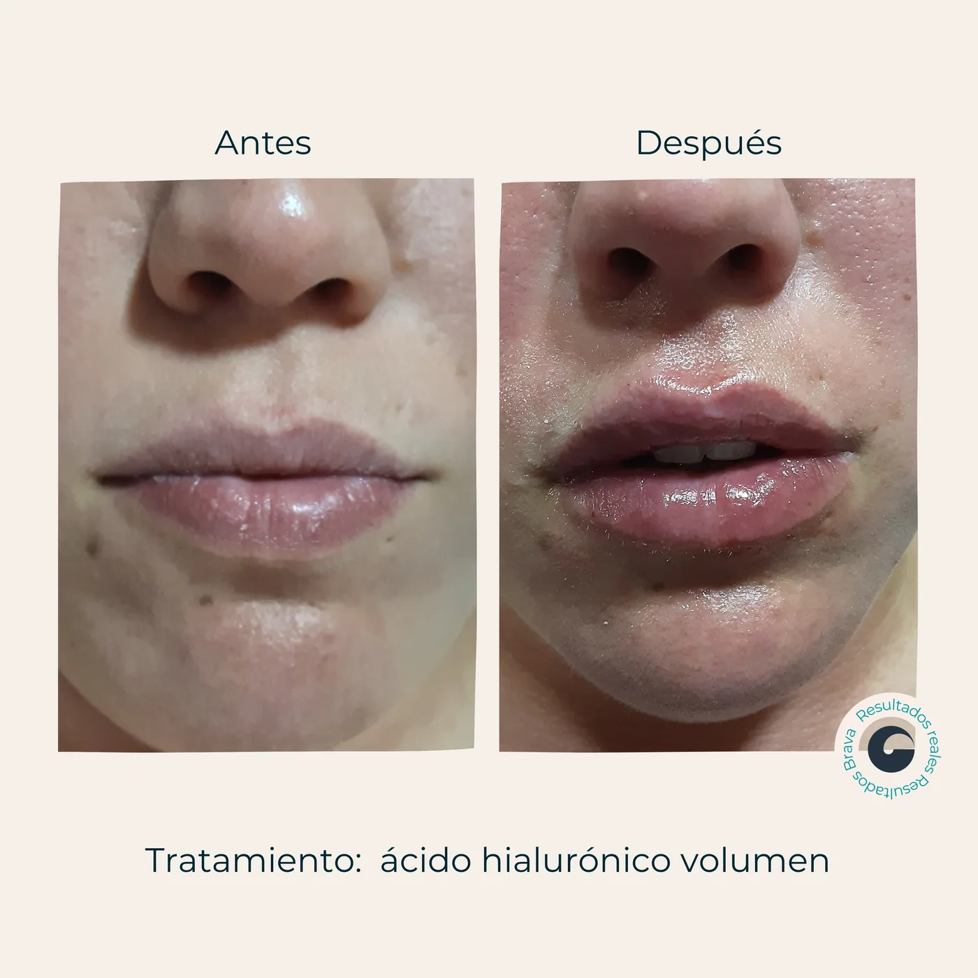 Antes y después real (8) documentado en Brava Clinic.