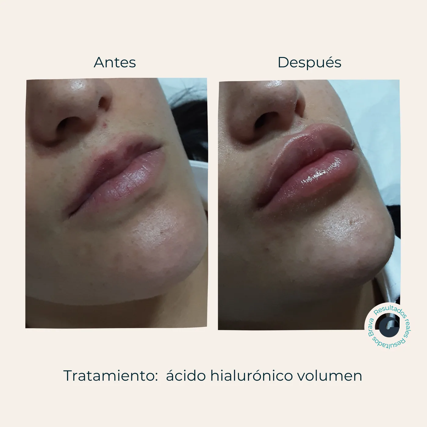 Antes y después real (9) documentado en Brava Clinic.